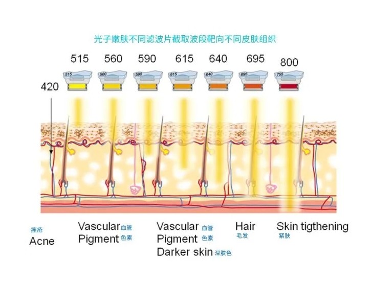 五大光子嫩膚技術(shù)（IPL、DPL、OPT、APT、BBL）及濾光片區(qū)別